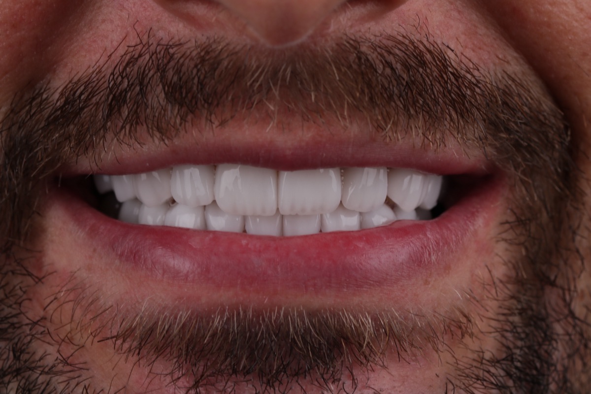 Nachher No-Prep-Veneers - Antony