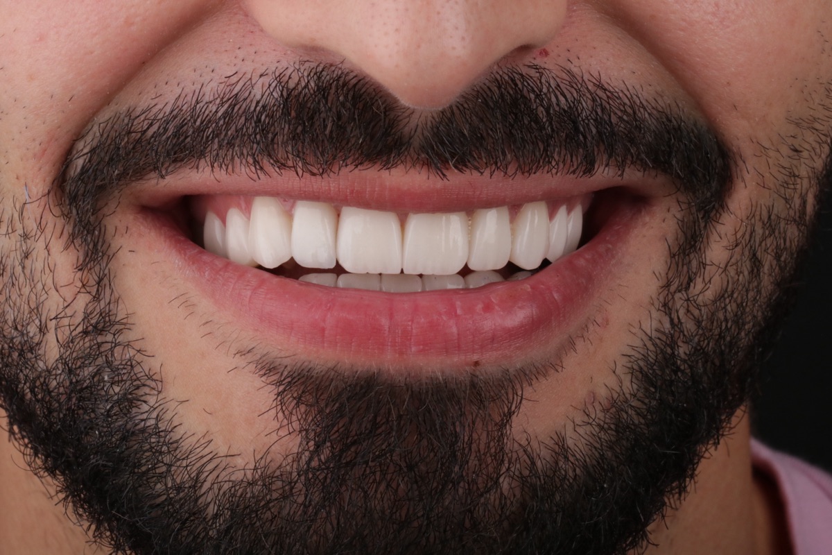 Nachher No-Prep-Veneers - Jamal